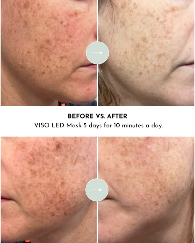 WellNest VISO™ Micro-LED Red Light Therapy Mask (FDA Certified)